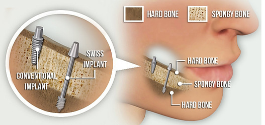 http://dr-riad.com/wp-content/uploads/2022/04/Basal-implants.jpg